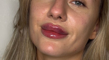 Enhanced lips with glossy finish at Paradox Aesthetics, Worcester, England, GB.