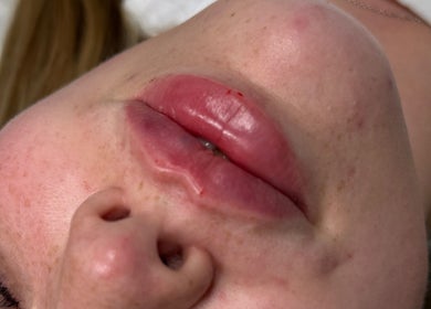 Close-up of enhanced lips at Paradox Aesthetics, Worcester, England, GB, showcasing expert beauty treatment.
