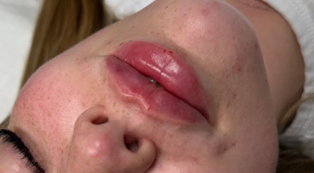 Close-up of enhanced lips at Paradox Aesthetics, Worcester, England, GB, showcasing expert beauty treatment.