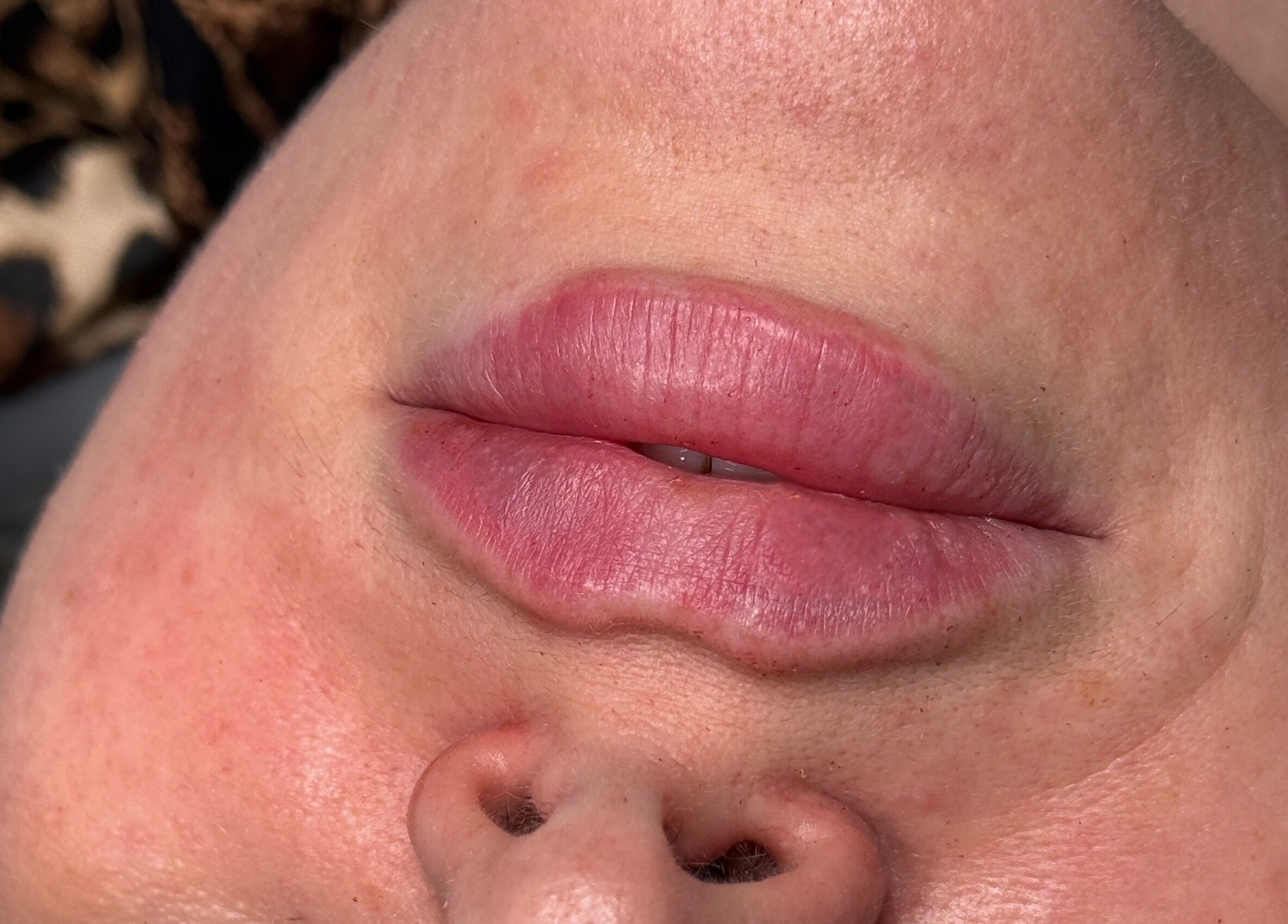 Close-up of enhanced lips at Paradox Aesthetics, Worcester, England, GB.