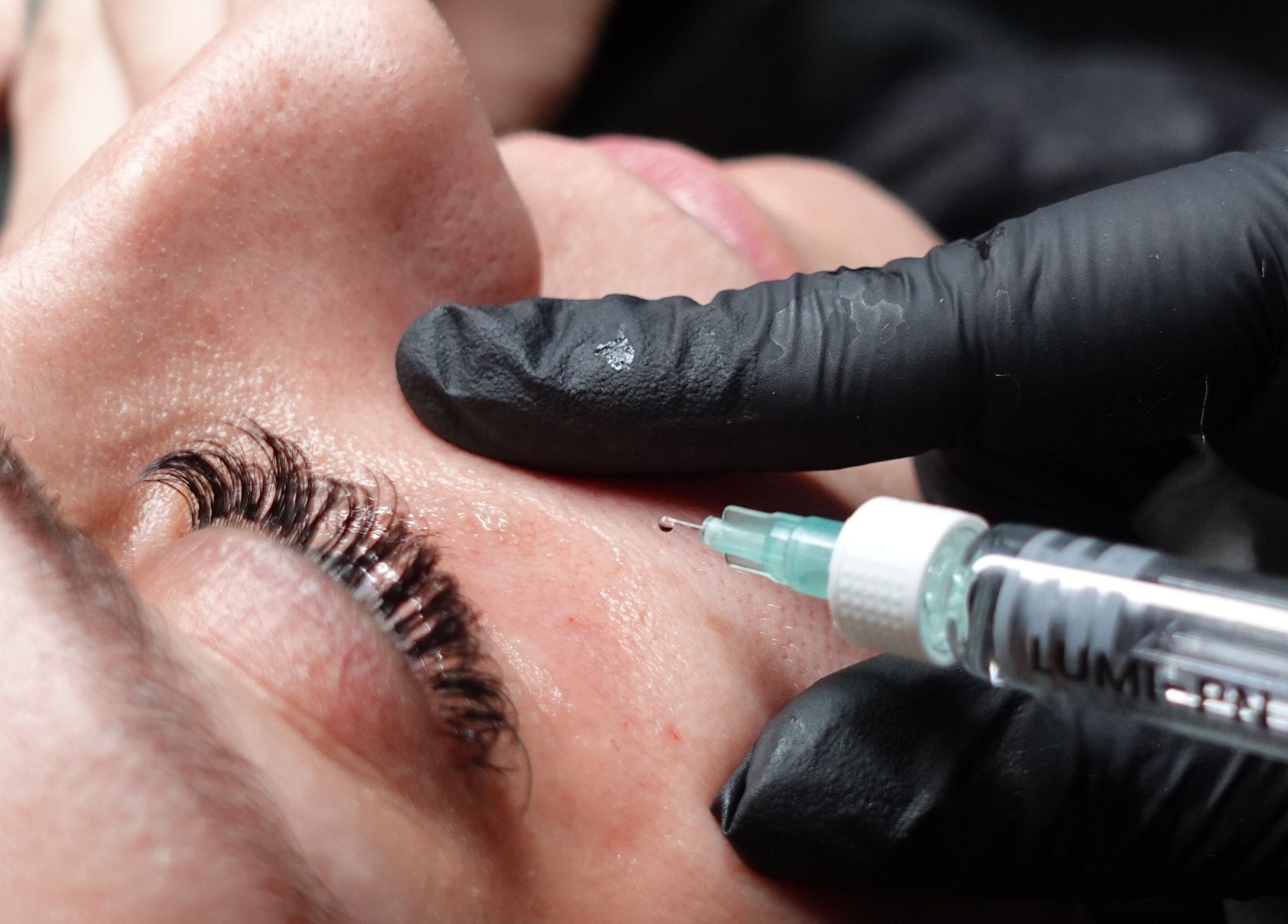 Facial treatment in progress at Paradox Aesthetics, Worcester, England, GB, showcasing skin rejuvenation.