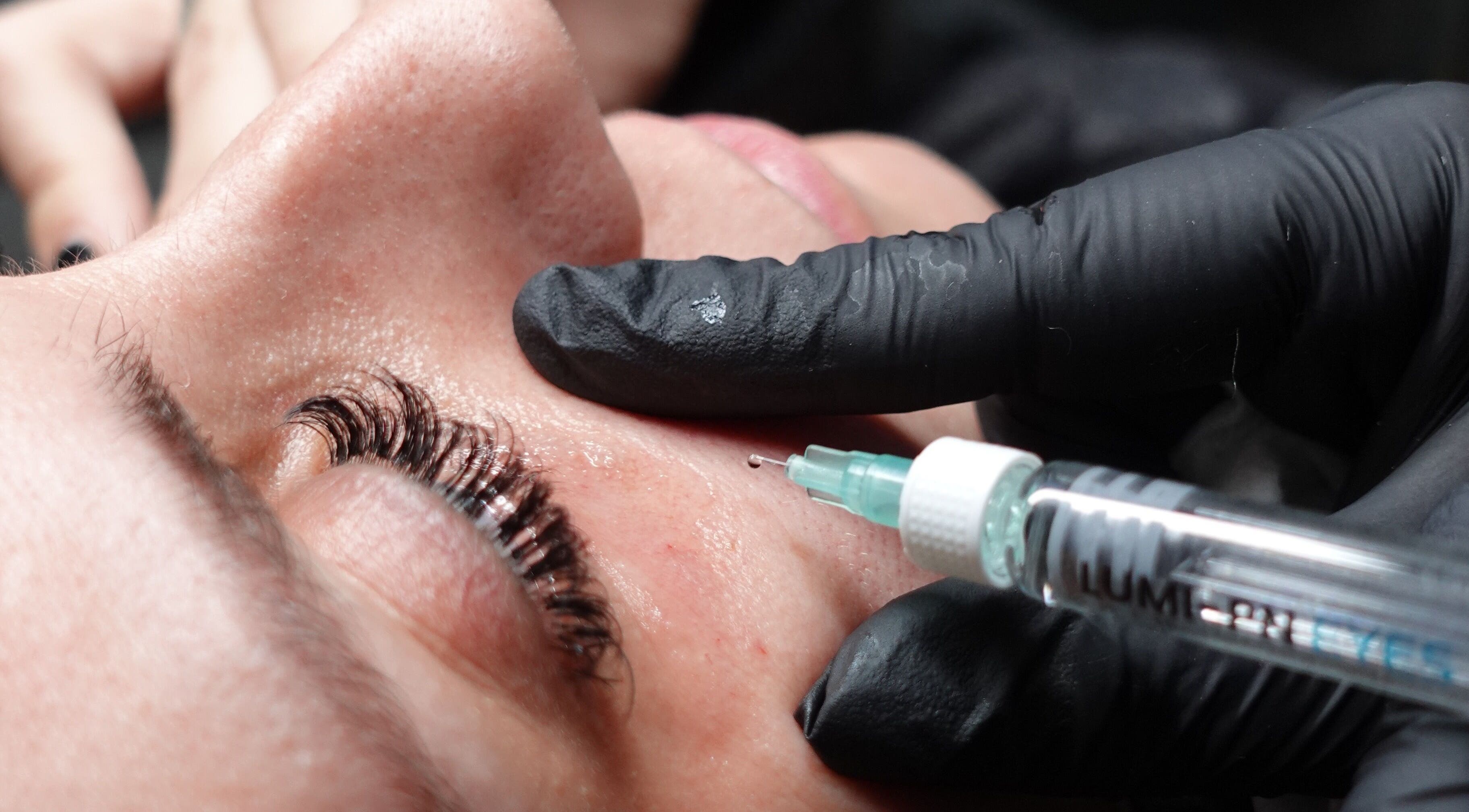 Facial treatment in progress at Paradox Aesthetics, Worcester, England, GB, showcasing skin rejuvenation.