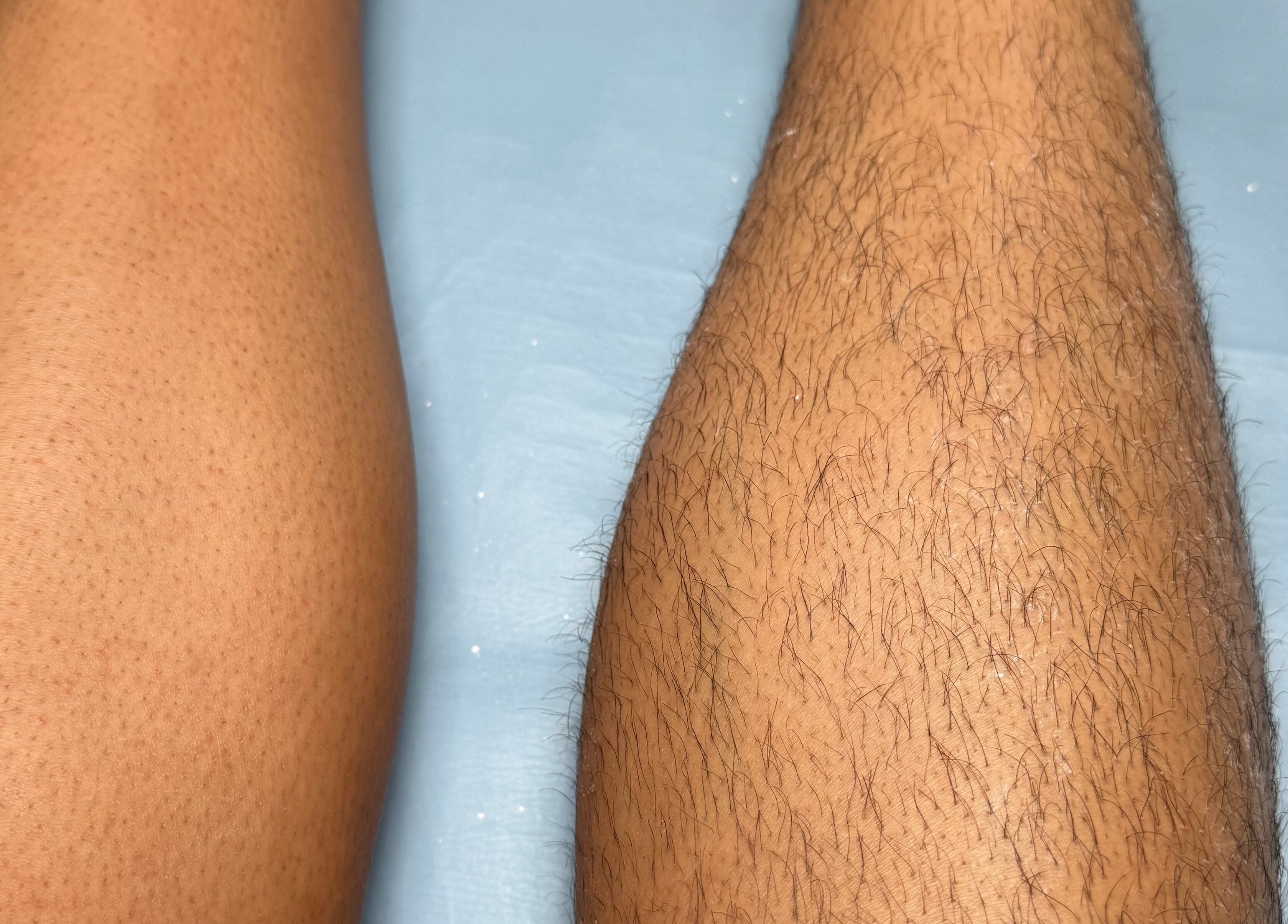 Smooth and hairless leg beside a hairy leg at The Wax Lounge Mauritius, Port Louis, Port Louis District, MU.