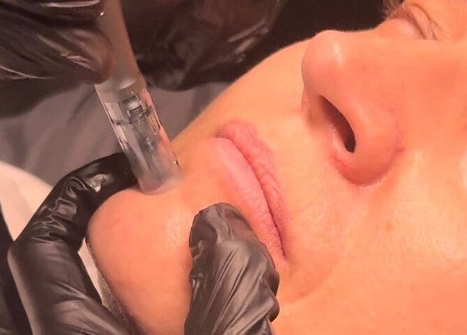 Facial skin procedure at Wild Winx Esthetics in Phoenix, Arizona, US, showing close-up of a skincare treatment.