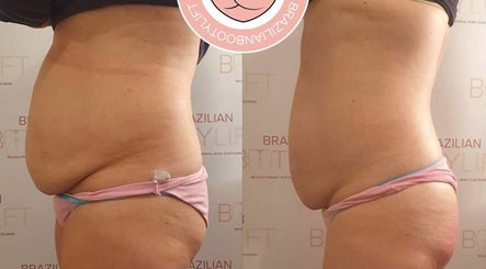 Bootyful Sheffield - Specialists In Body Contouring изображение 3