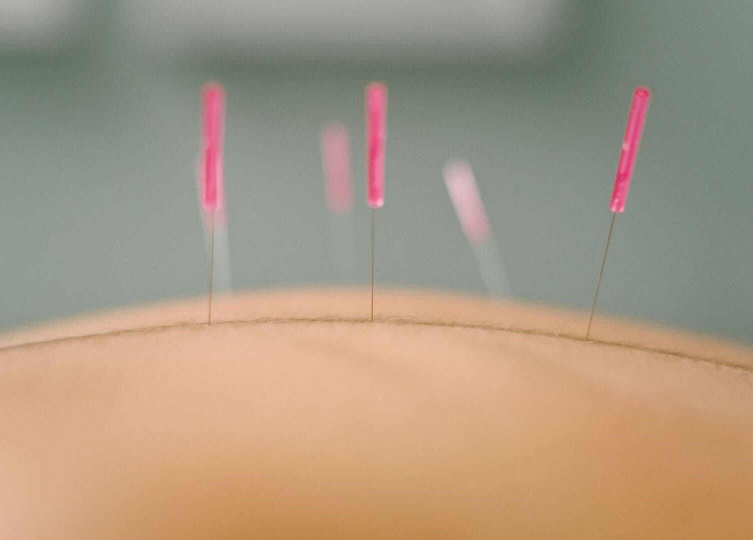 Acupuncture needles in session at Acupuncture with Natalie, Lowestoft, England, GB.