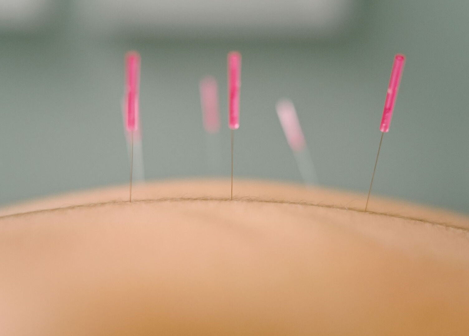 Acupuncture needles at Acupuncture with Natalie in Lowestoft, England, GB for holistic wellness.