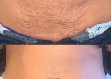 Before and after tummy transformation at The Sculpt Squad, Caterham, England, GB.