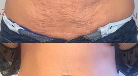 Before and after tummy transformation at The Sculpt Squad, Caterham, England, GB.