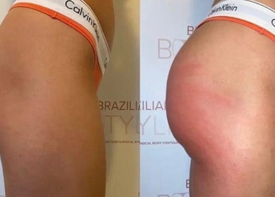 Before and after body contouring at The Sculpt Squad, Caterham, England, GB showcasing enhanced curves.