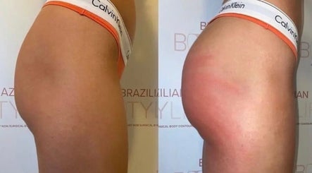 Before and after body contouring at The Sculpt Squad, Caterham, England, GB showcasing enhanced curves.