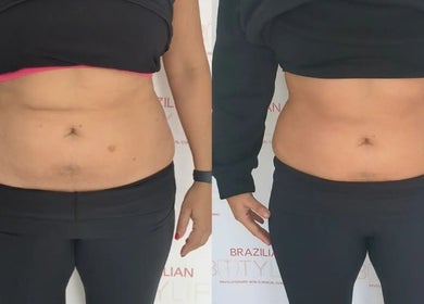 Before and after results of a body contouring treatment at The Sculpt Squad, Caterham, England, GB.