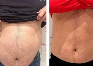Before and after body transformation by The Sculpt Squad in Caterham, England, GB.