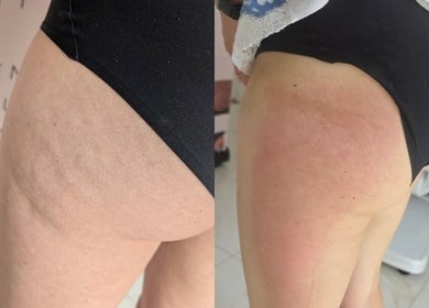 Before and after skin treatment at The Sculpt Squad, Caterham, England, GB, showcasing reduced cellulite.