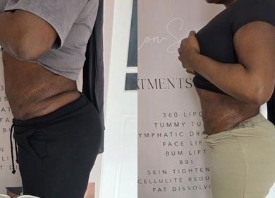 Before and after body contouring at The Sculpt Squad, Caterham, England, GB.