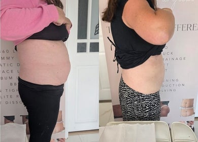 Before and after body transformation at The Sculpt Squad, Caterham, England, GB showing visible slimming effect.