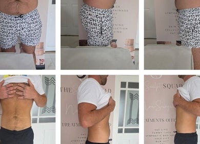 Before and after body contouring at The Sculpt Squad, Caterham, England, GB. Visible improvements post-treatment.