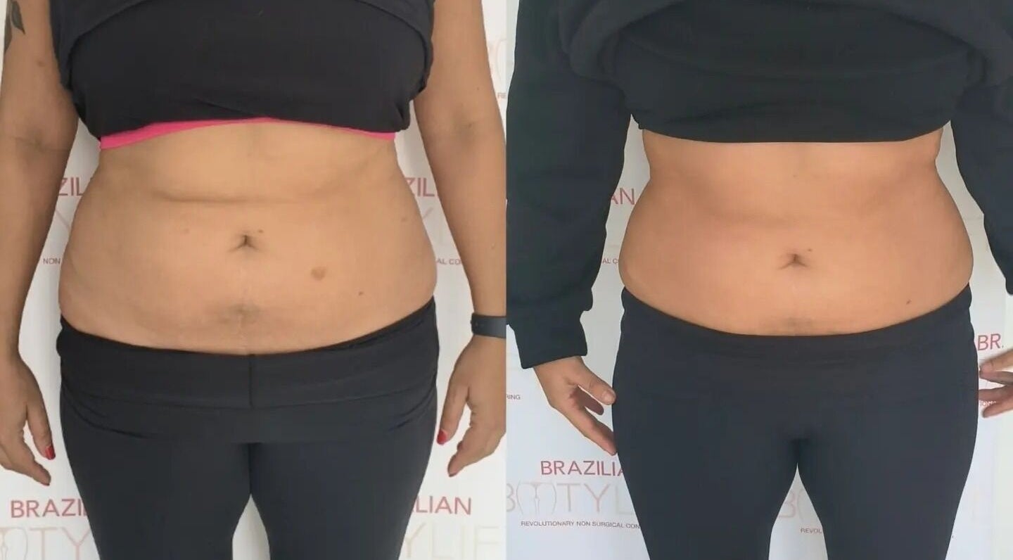 Before and after body contouring at The Sculpt Squad, Caterham, England, GB showcases impressive results.
