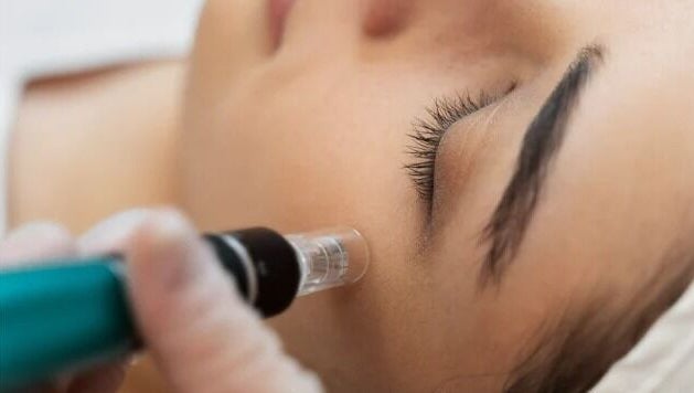 Close-up of microneedling at MUD Studio Manila, Mandaluyong, Metro Manila, PH.