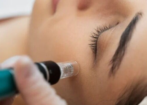 Close-up of microneedling at MUD Studio Manila, Mandaluyong, Metro Manila, PH.
