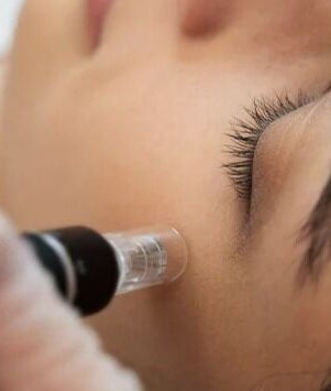 Close-up of microneedling at MUD Studio Manila, Mandaluyong, Metro Manila, PH.