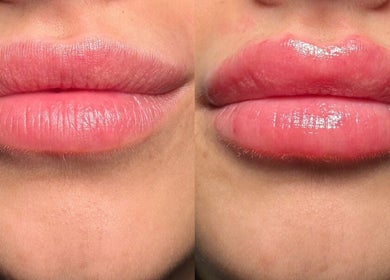 Lip enhancement before and after at Ania Aesthetics - L & Co Beauty in Market Deeping, England, GB.
