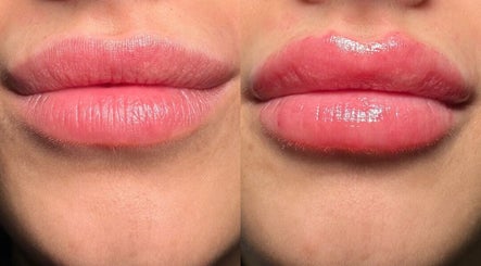 Lip enhancement before and after at Ania Aesthetics - L & Co Beauty in Market Deeping, England, GB.